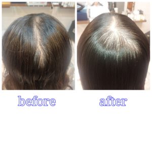 大野城美容室Lien hair design (リアンヘアーデザイン)『ヘアリセッター』&『ヒト幹細胞トリートメントスパコース』のお客様です！ くせ毛で髪がひろがってしまう・・・ つむじ、前髪が割れてうすくみえる・・・ 美容室ではキレイでも自分ではうまくセットできない！ 皆さんはこのような悩みをお持ちではないでしょうか？ 今まで美容室でこのような悩みを打ち明けても、　”生えグセなのでしょうがないです”　と言われ、諦めたりしてきていませんか？ 実はこれリアンなら改善できちゃいます！ そのような方に効果的なのがこのヘアリセッター です😊 長さを変える事なく、薬剤など一切使わずに、このような悩みを解決できます！ ■どのような悩みが改善できるのか 一般的に、髪の毛は１つの毛穴から２～５本はえています。 目ではわかりにくいのですが、その髪の毛たちは絡まりあってはえています。 その絡まりが原因で ・髪が広がってしまう。 ・前髪、襟足、つむじの割れ、浮き。 ・トップのボリュームが出ず、ペタッとする。 ・手触りが悪い。 ということがおこってしまいます。 ヘアリセッターとは髪の根元の絡まりをとり、生えグセの強い髪のみを1本単位で根元から施術することにより、髪の長さを変えずにあなたの悩みを改善にみちびいてくれる魔法の技術なのです😁 髪の根元の絡まりをとるとどうなるのでしょうか。 ・髪の広がりが収まる。 ・前髪、つむじが割れにくくなる。 ・襟足が落ち着いて沿いやすくなる。 ・トップのボリュームが出やすくなる。 ・ツヤ、手触りが良くなる。 ということがおこります！ こちらのつむじの割れ目が気になっていたお客様もブローやドライ、もちろんアイロンもなしで『ヘアリセッター』のみで、こんなに綺麗に分け目を修正することができちゃいます😊 しかもドライヤーで風を吹き付けても今までのようにパカーンと割れることはないのです😆 ・前髪が生え癖で割れてしまう。 ・トップにボリュームがでない。 ・トップが膨らんでしまう。 ・つむじが割れてしまう。 これも全て下から持ち上げる毛や上からへばり付かせる髪が原因なのです😩 その原因になってる髪だけにピンポイントでアプローチすれば、こんなに艶々で綺麗に改善できちゃいます！ ■持ちは？ 基本的に約1ヶ月が持続期間です。 髪の毛は1ヶ月で約1センチ～1.5センチ伸びますので、伸びた毛が絡まり出すと生えグセが戻ってきます。しかし、完全に元に戻る前に施術を繰り返していくと、持ちや効果が良くなっていきます。 更に『ヒト幹細胞トリートメントスパ』をすることにより、炎症して変色していた頭皮も綺麗な白く透明感のある頭皮へと導きボリュームも改善しているのが分かります！ 前髪やつむじなどの生え癖で悩まれているお客様、是非１度『ヘアリセッター』や『ヒト幹細胞トリートメントヘッドスパ』をお試しになられてください😊 ※ご予約はお電話または公式LINEアカウントで承らせていただいております！ (公式LINEアカウントはホームページのトップ画面からご登録いただけます) 「髪質改善」美容室 リアン ヘアデザイン 福岡県大野城市中央２丁目１−１３ tel:092-593-3339 ※完全マンツーマンサロンですので、 お電話の対応、施術、会計など 全てひとりで担当させていただいております。 そのため施術中はお電話が取れない場合がございます。 その際は折り返しご連絡をさせていただきます。 「髪質改善専門サロン」Lien hair design（リアンヘアデザイン）｜福岡 大野城市駅すぐの美容室 #Lienhairdesign #リアンヘアデザイン #福岡美容室 #大野城美容室 #大野城髪質改善 #福岡髪質改善 #髪質改善 #縮毛矯正 #頭皮診断 #艶髪 #くせ毛 #アホ毛 #枝毛 #パサつき #ダメージヘア #40代髪質改善 #福岡 #福岡県 #大野城 #大野城市 #福岡県大野城市 #ヘアリセッター #大野城市美容室 #大野城駅 #頭皮マッサージ #頭皮ケア #ヘッドスパ #つむじ割れ #つむじ割れ解消 #ヒト幹細胞