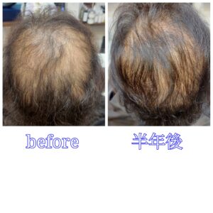 大野城予防美容専門美容室Lien hair design(リアンヘアデザイン)髪質改善や美髪のイメージの強い当店なのですが何気に隠れた大人気『育毛』メニュー『ヒト幹細胞髪育プログラムBスカルプメソッド』を開始されて半年後のお客様です！

若い頃からヘアカラーや縮毛矯正やパーマなどの繰り返しによる頭皮ダメージから頭皮の乾燥&髪が細くなりハリコシがなくなったり、毛量が減りオデコや頭頂部の頭皮が透けて見えるなど薄毛を気にされていたお客様の髪もリアンの『ヒト幹細胞髪育プログラム』を施術されて半年で頭皮が突っ張ったりなどの乾燥が気にならなくなり、トップのボリューム&頭皮が透けて見えるお悩みが改善された来てるのが分かります(^ー^)

お客様ご自身も発毛と髪のハリコシとともに白髪の改善を実感され、外出の際に気にされていた人目が気にならなくなったと喜ばれてました(^ー^)

こちらの『ヒト幹細胞髪育プログラムBスカルプメソッド』はAコースに更に速効性をもたせハリ、コシを実感していたはだけるとともに究極のスカルプケアを実感いただけるコースとなっております！

5αリダクターゼ(皮脂)と男性ホルモン(テストステロン)の結合を抑えることができず、薄毛の原因となる悪玉菌(DHT)を生成。悪玉菌が毛根を攻撃し、発育を阻害。薄毛が進行してしまいます。
(女性も妊娠を機にテストステロンが増えることで同じ現象が起き、産後の抜け毛へと繋がります。)

リアンの『ヒト幹細胞髪育プログラム』は
毛穴の浄化→毛細血管の拡張活性化→毛母細胞の増殖・分化促進を促すことで

①5αリダクターゼを抑える
②薄毛の原因・悪玉菌がを抑制
③頭皮環境を整える

①②③全ての役割を果たし原因を改善していきます！

リアンと言えば髪質改善や美髪、ヘアケアのイメージが強いと思いますが、美しい髪は美しい頭皮から！

実は美髪メニューと同じくらいに育毛メニューも大人気なのです(^ー^)

今、話題のヒト幹細胞培養液を使った強く美しい髪を育むエイジングケアの革新的アプローチ！

年齢に負けない強く美しい髪を取り戻す！

・日に日に増える抜け毛
・落ちない頭皮の汚れ
・コシのない細毛
・気になる薄毛
・ハリのないうねり毛

などでお悩みのお客様もリアンの『髪育プログラム』で究極のスカルプケアを実感していただくことで美髪スイッチをオンにさせていただきます！

頭皮トラブルを防ぎ、成長期を延ばす！

毛穴の浄化→毛細血管の拡張活性化→毛母細胞の増殖・分化促進

にアプローチする事で

抜けない頭皮環境=成長期を延ばす!!

ヒト幹細胞髪育プログラムAメソッド

￥13200(税込)

(抜け毛、酸化した皮脂、細毛、薄毛、細胞の不活性化にアプローチ頭皮環境を整え、強く美しい髪が蘇るだけでなく、顔全体のリフトアップ効果も期待できます)

ヒト幹細胞髪育プログラムBスカルプメソッド

￥16500(税込)

(Aコースに更に速効性をもたせハリ、コシを実感していただけるとともに究極のスカルプケアを実感いただけるコースとなっております)

を定期的に(理想は2週間に1度)施術させていただき、ご家庭で使われてるシャンプー、トリートメントを代えていただくだけで効果を実感できると思います(^-^)

より効果を早く実感されたい方は専用の育毛剤やサプリメント、ヘッドスパやデンキバリブラシを使用したエレクトロポレーションなどのオプションメニューもございます！

リアンのヒト幹細胞を贅沢に使用し細胞レベルに働きかける『ヒト幹細胞髪育プログラム』であなたも美しい頭皮と美髪を手に入れませんか(　＾▽＾)

「髪質改善」美容室 リアン ヘアーデザイン

福岡県大野城市中央２丁目１−１３

tel:092-593-3339

※完全マンツーマンサロンですので、
お電話の対応、施術、会計など
全てひとりで担当させていただいております。
そのため施術中はお電話が取れない場合がございます。
その際は折り返しご連絡をさせていただきます

#福岡薄毛
#福岡育毛
#薄毛
#育毛
#増毛